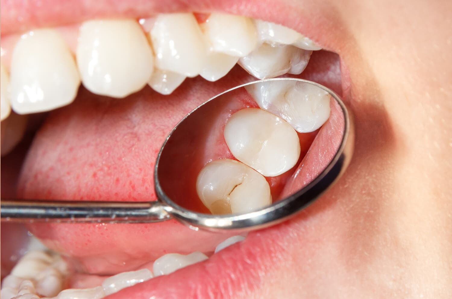 Endodoncia