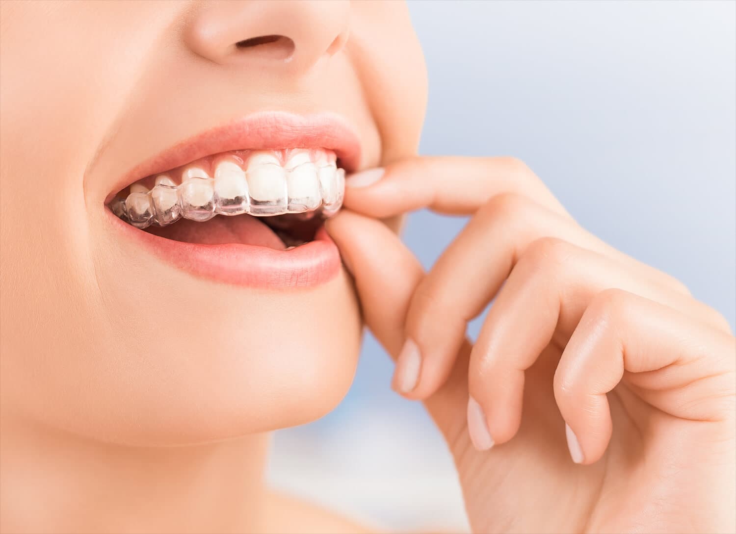 Invisalign, lo último en ortodoncia invisible